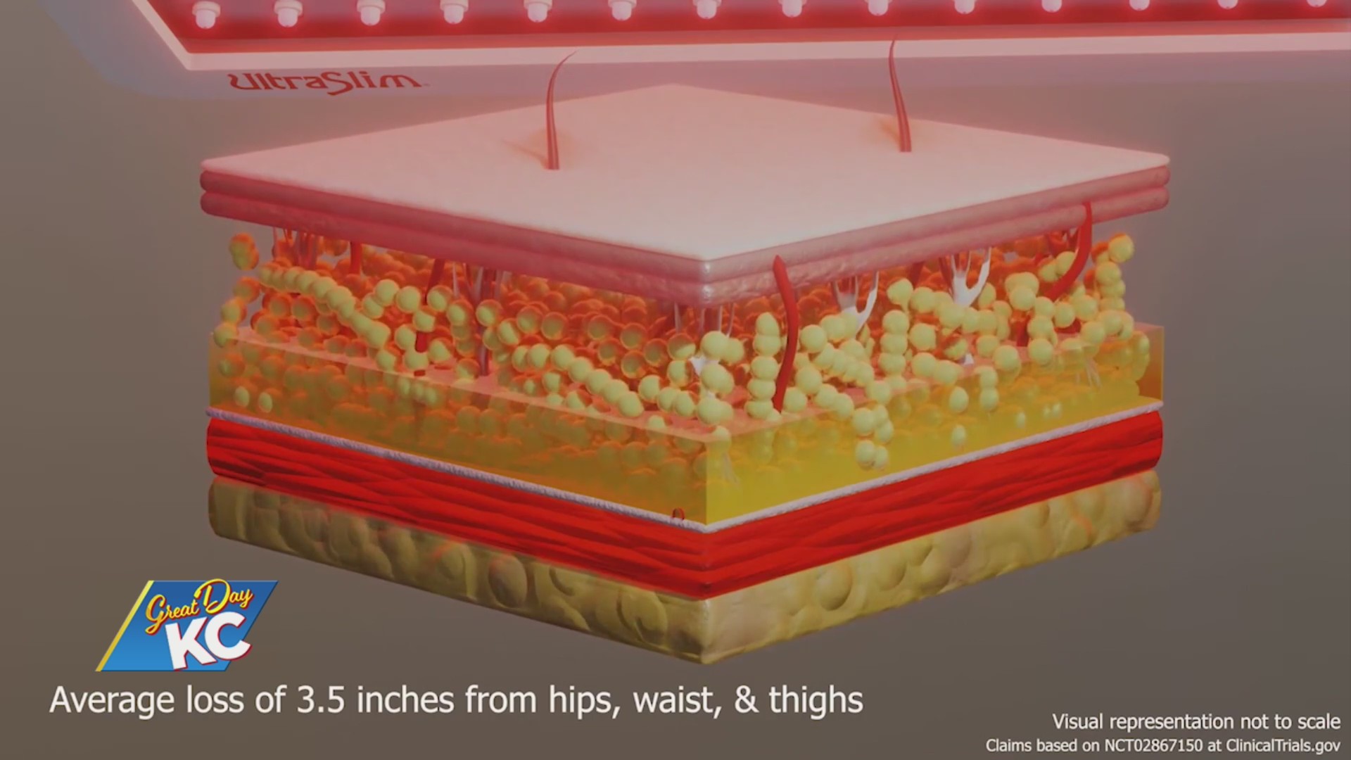 The ‘Ultra’ Ways To Shrink Fat Cells FOX 4 Kansas City WDAFTV News