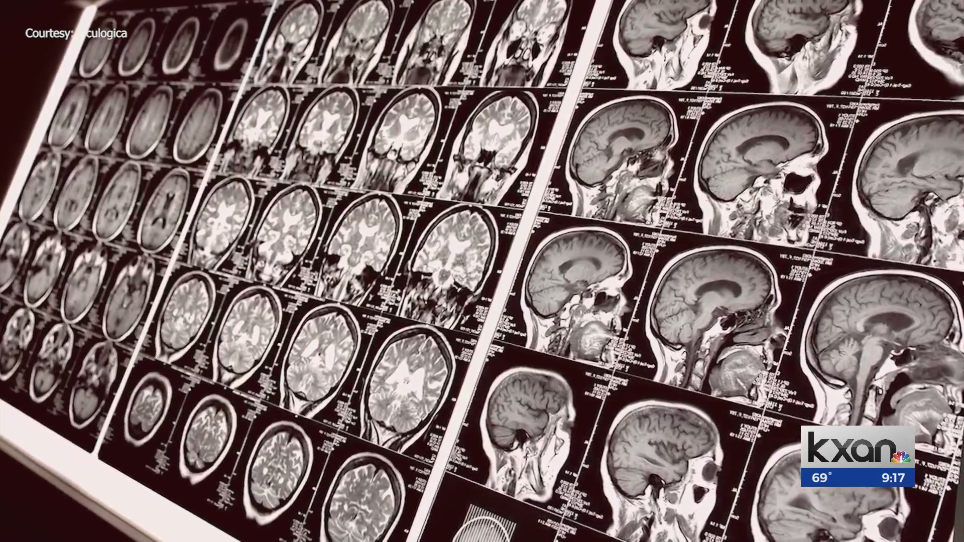 EyeBOX concussion testing in Round Rock – KXAN Austin