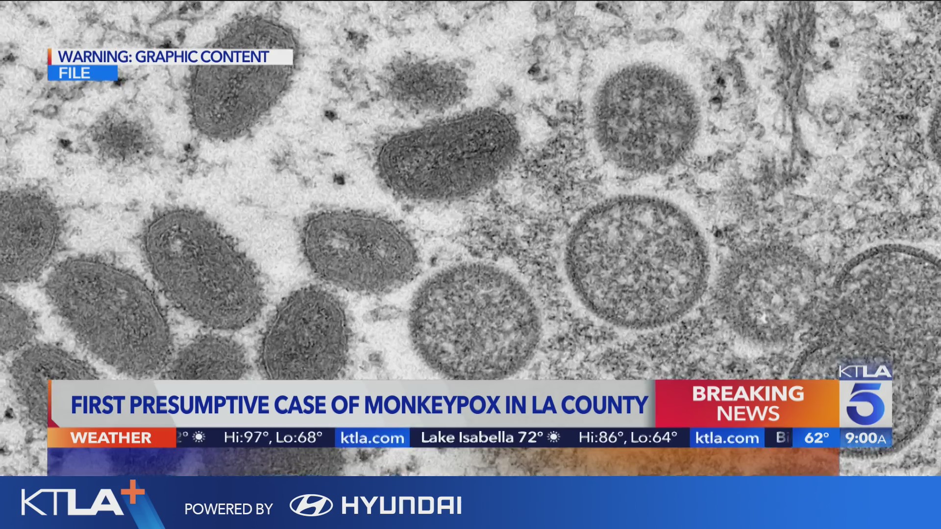 L.A. County confirms 1st presumptive case of monkeypox – KTLA