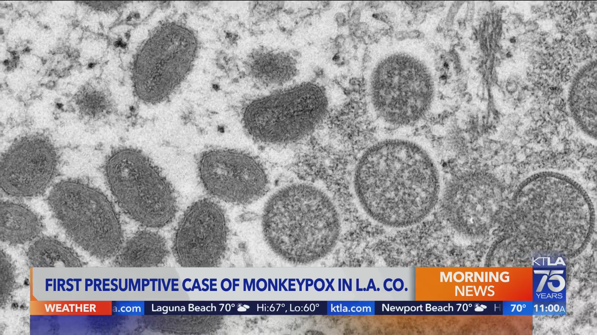 L.A. County confirms 1st presumptive case of monkeypox – KTLA