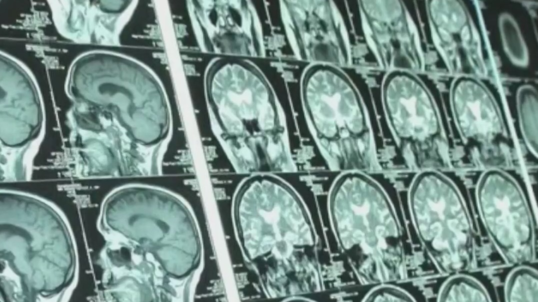 40% of athletes in study who died before the age of 30 had CTE ...