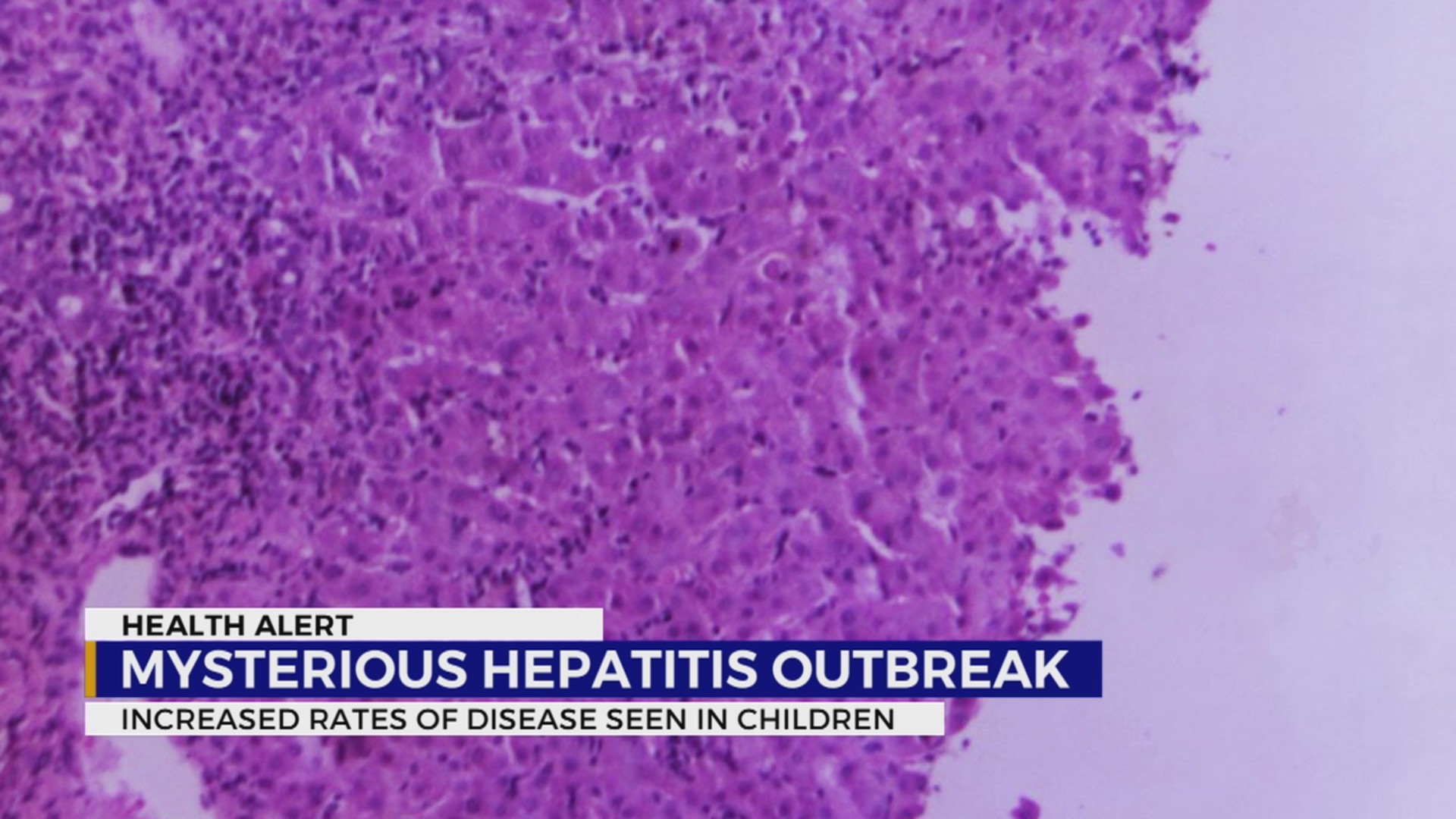 Mysterious Hepatitis Outbreak, CDC report WKRN News 2